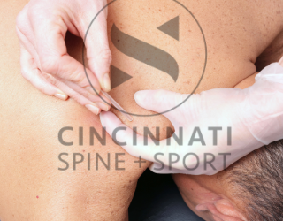 The Benefits of Dry Needling for Shoulder Impingement